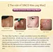 laser hair removal